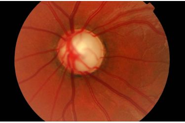 nerve-patient-glaucoma
