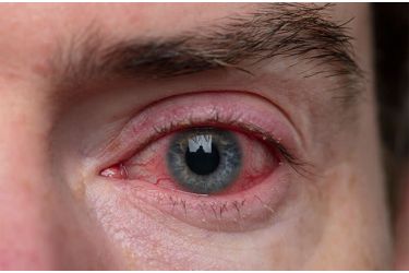 swollen-eyelids-blepharitis-hero